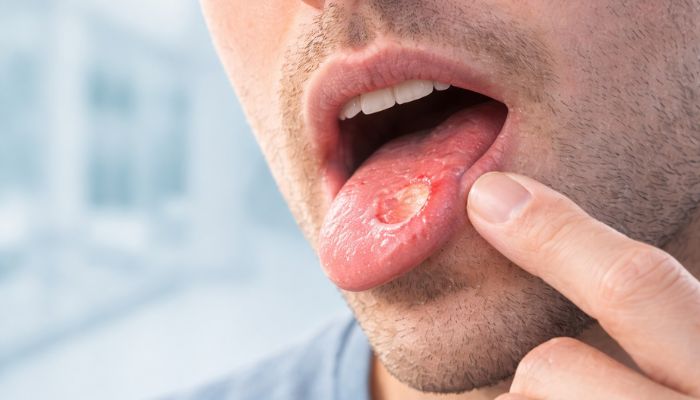 Triamcinolona en mucosa oral: no es solo el corticoide, es el vehículo